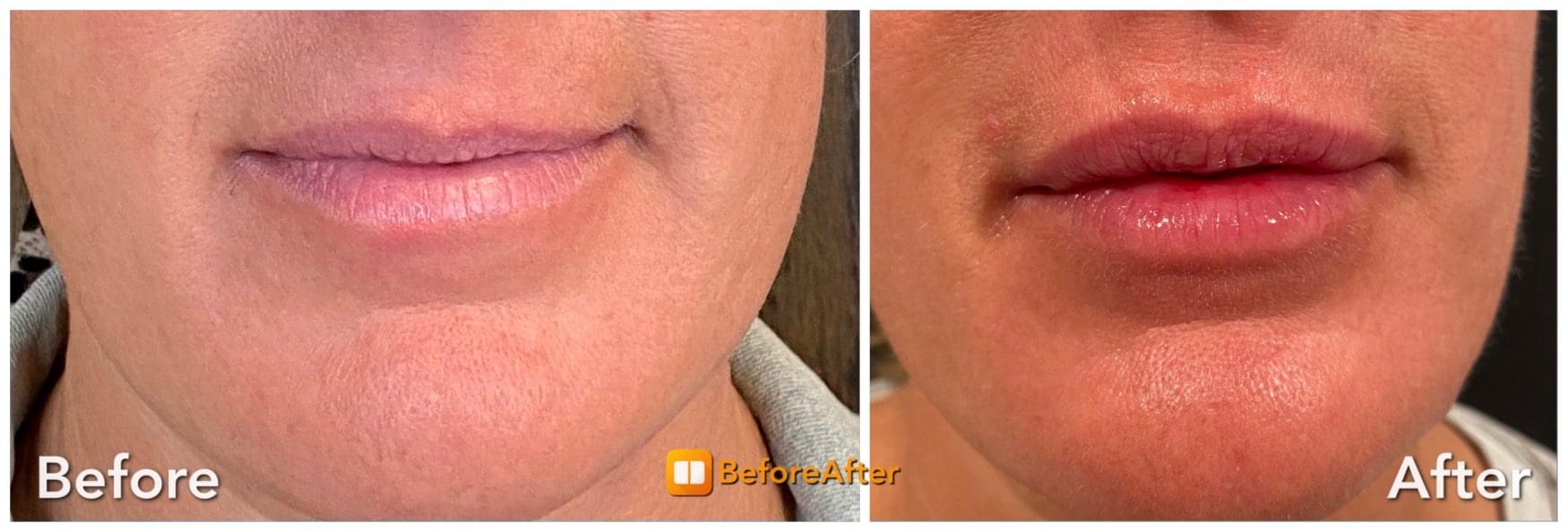 Before-and-after lip enhancement close-up