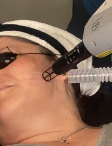 Person wearing eye protection during facial laser treatment