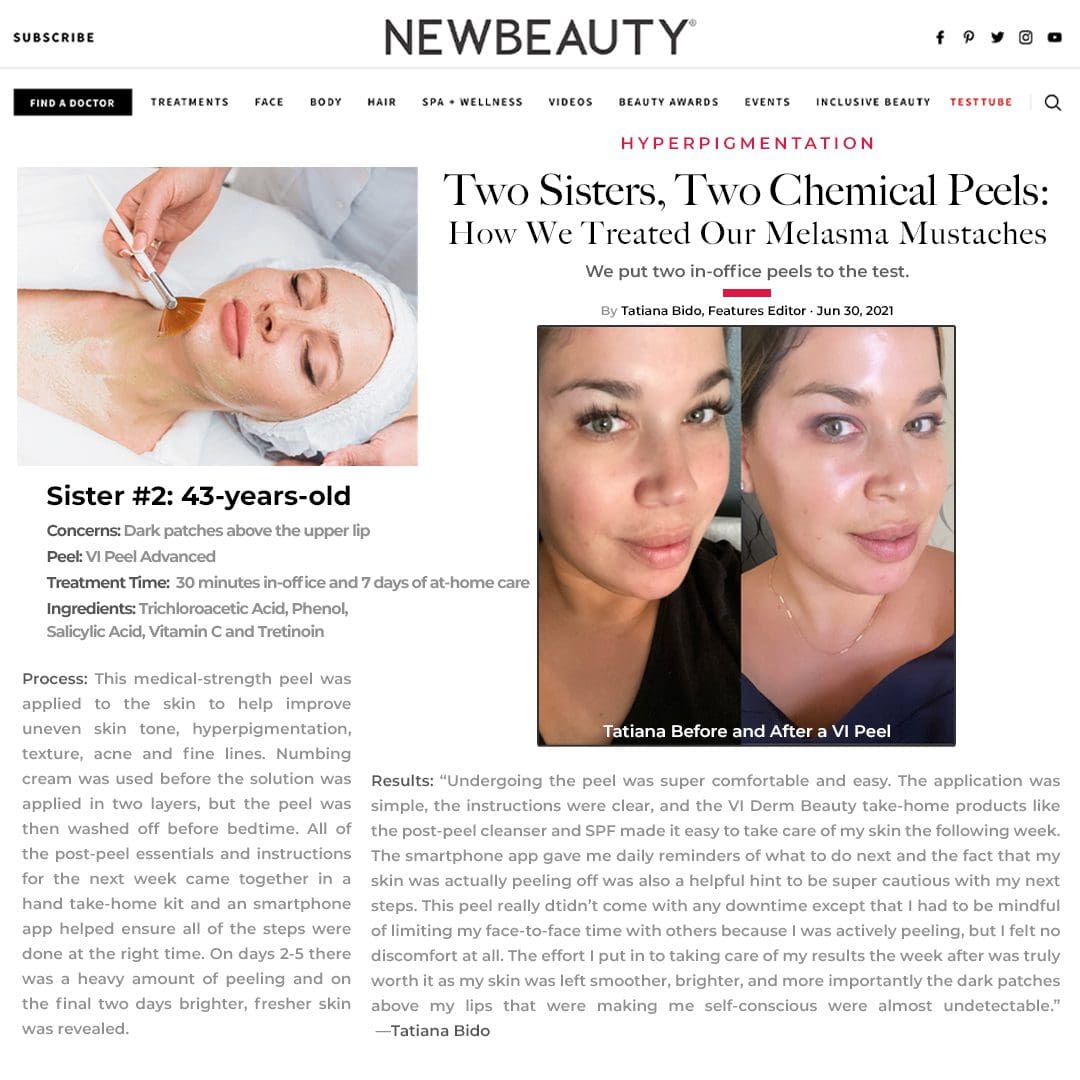 Vi Peel Before And After
